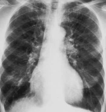 Liêu pháp OXY cho Bệnh phổi tắc nghẽn mạn tính (COPD)